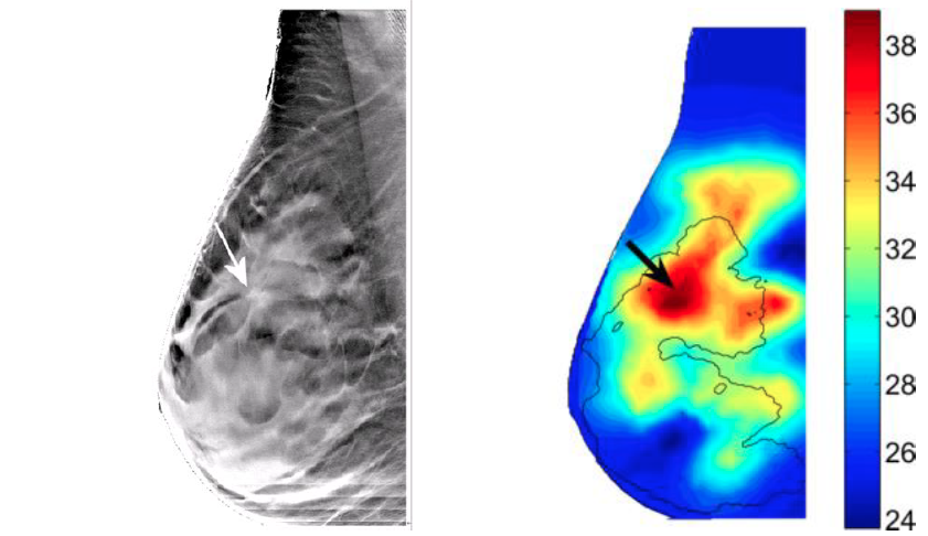 Imaging in Breast Cancer